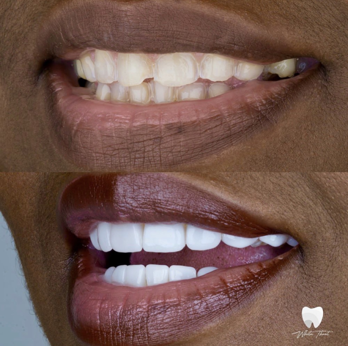 Tratamiento estético dental