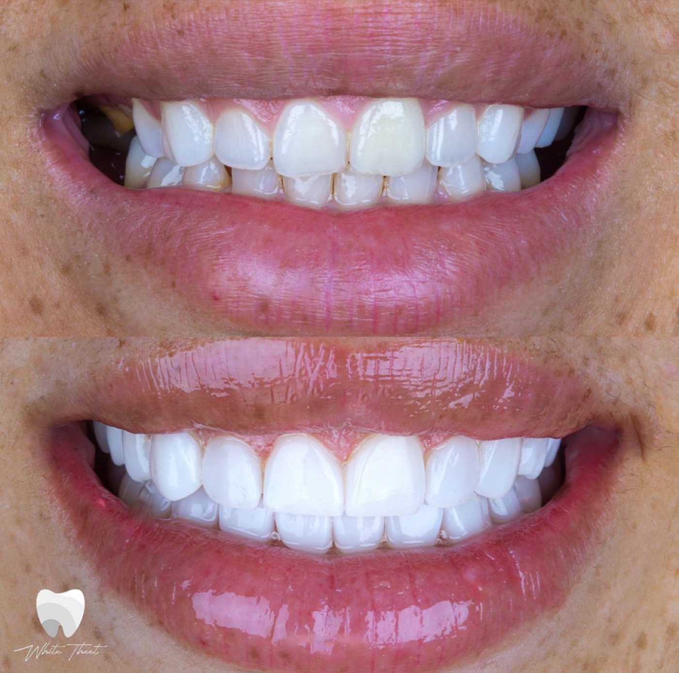 Antes y después de sonrisa