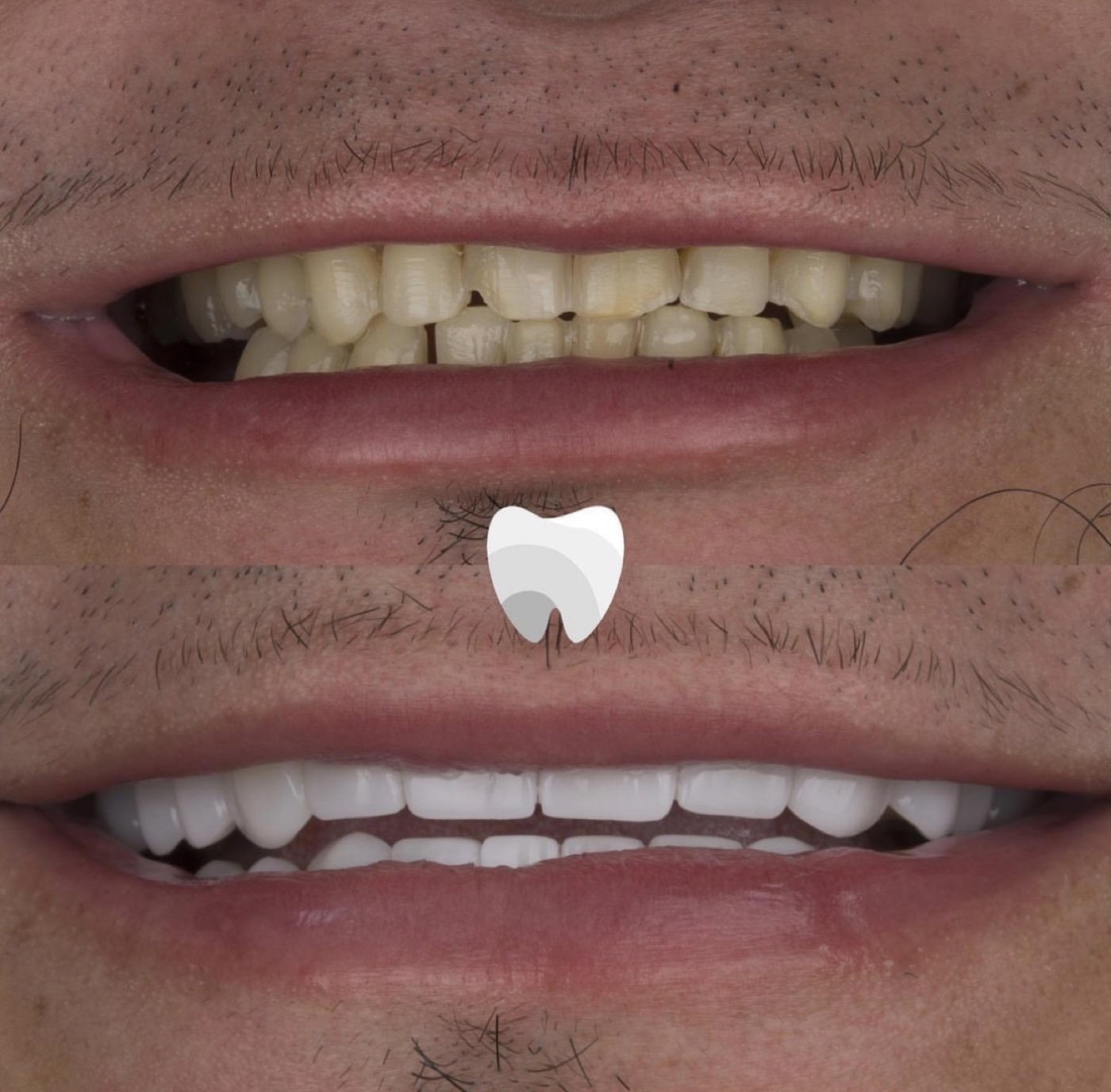 Carillas dentales Colombia