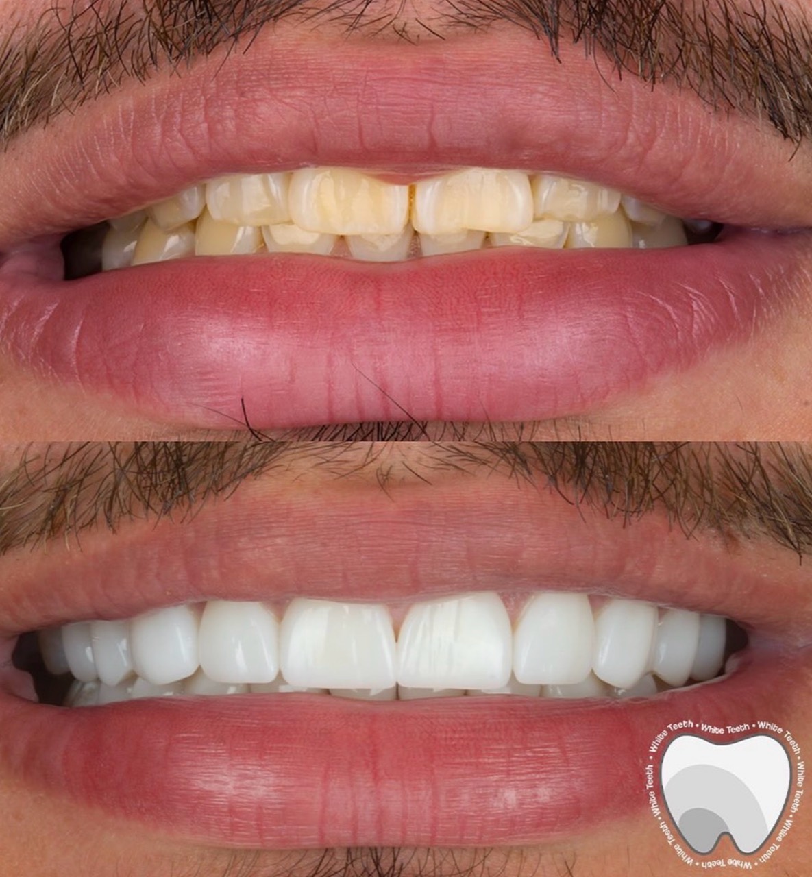 Before and after porcelain veneer result in Colombia