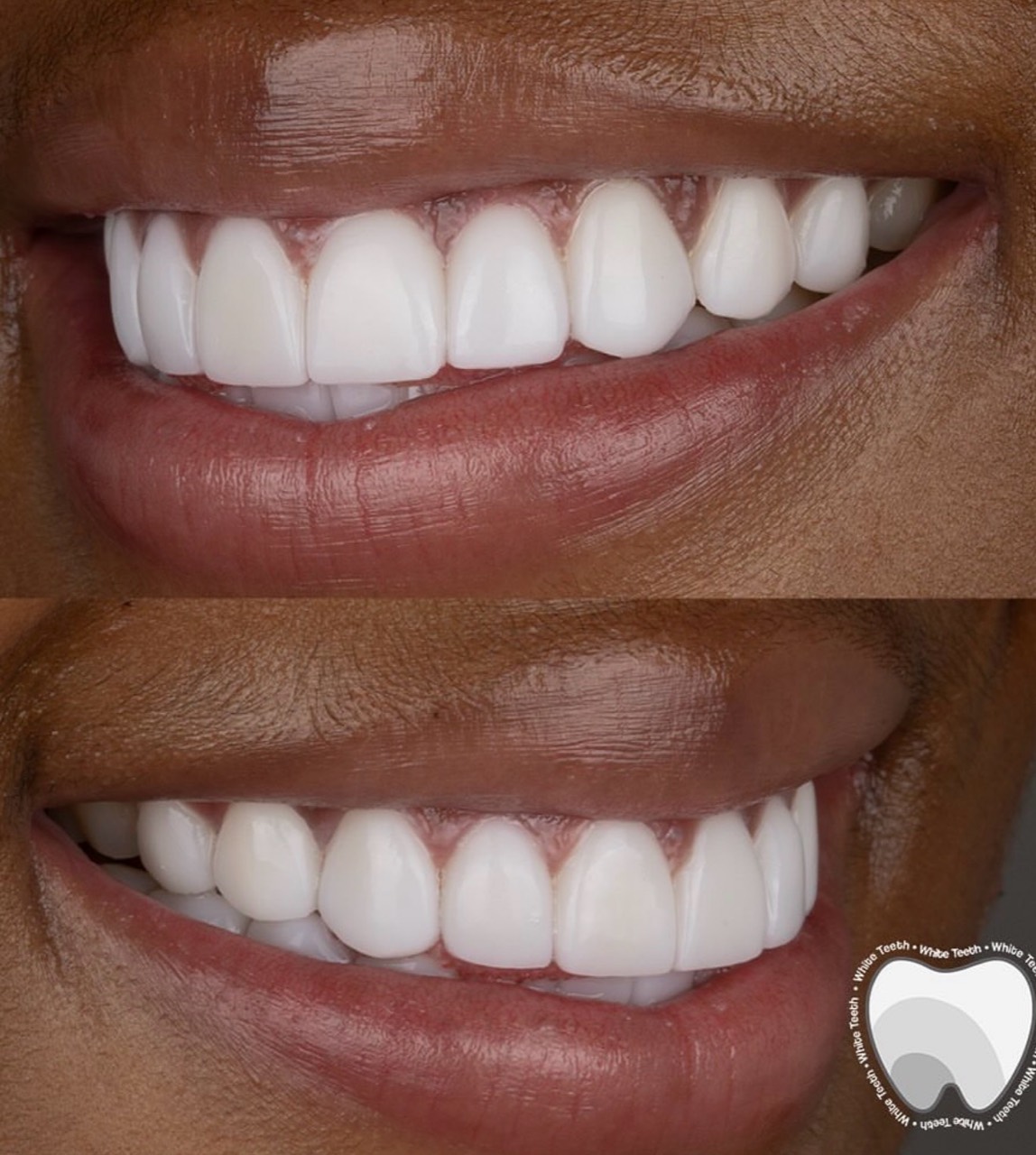 White Teeth Colombia porcelain veneers result