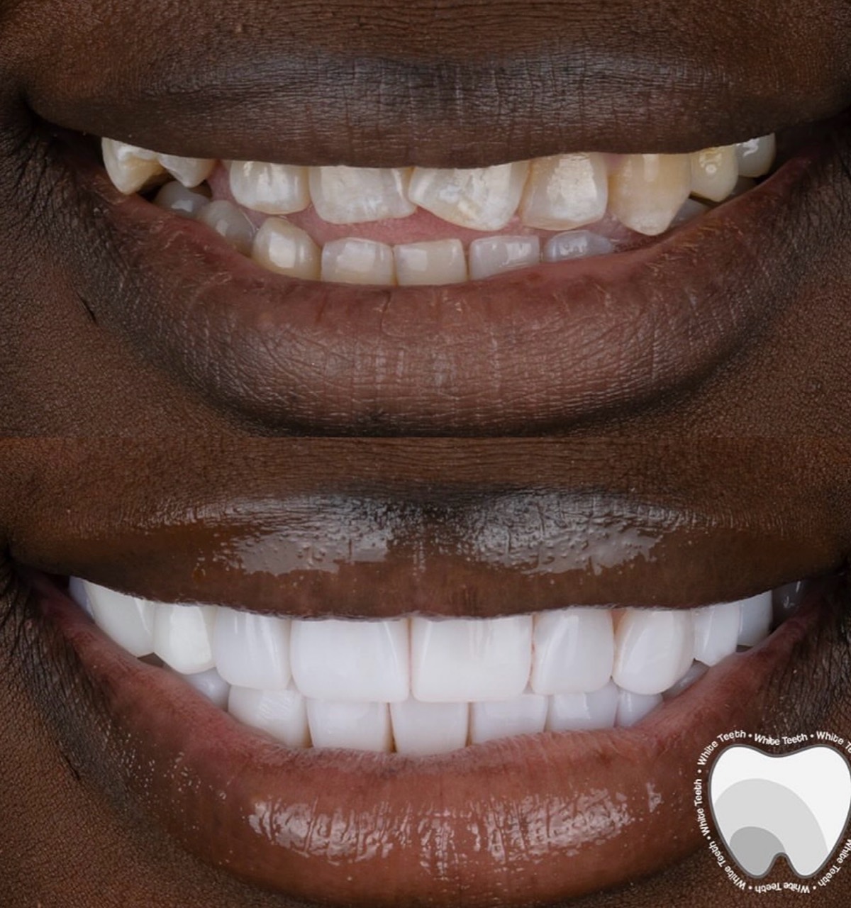 Full smile rehabilitation before and after
