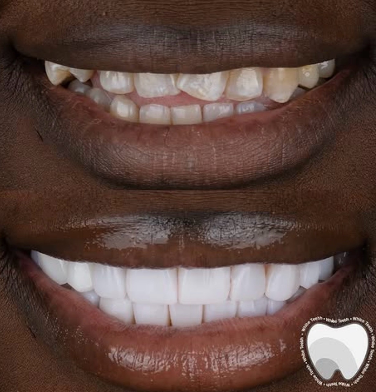 White veneers result for international patient