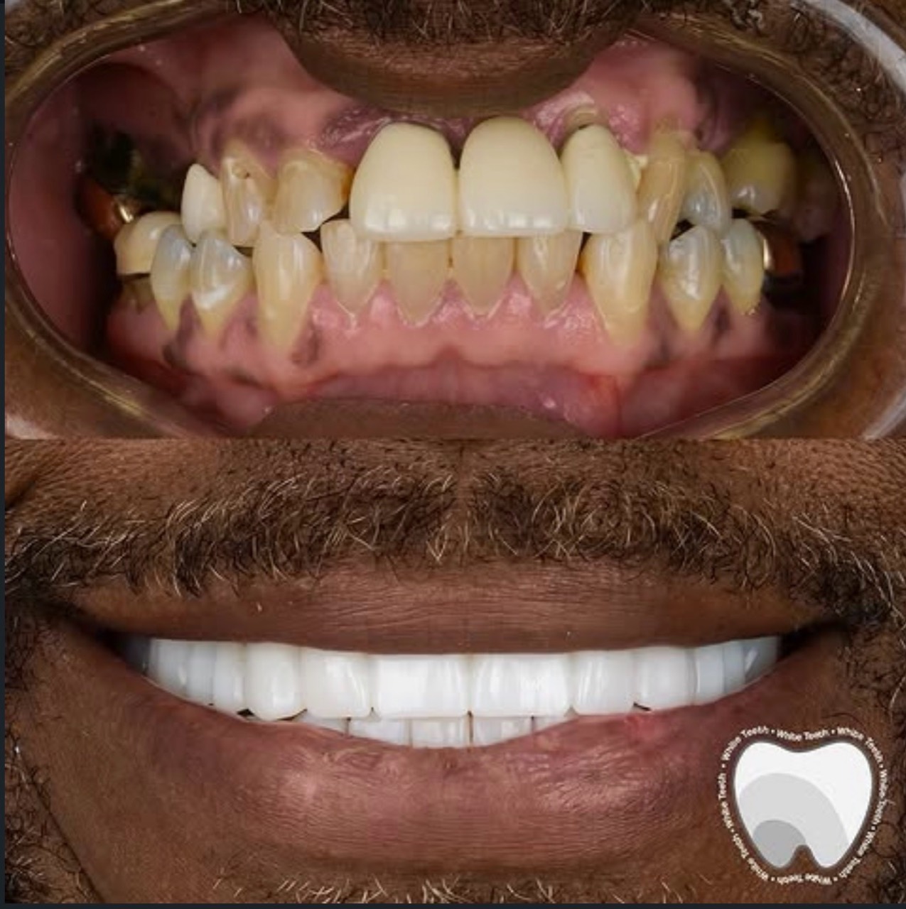 Complete dental transformation in Colombia