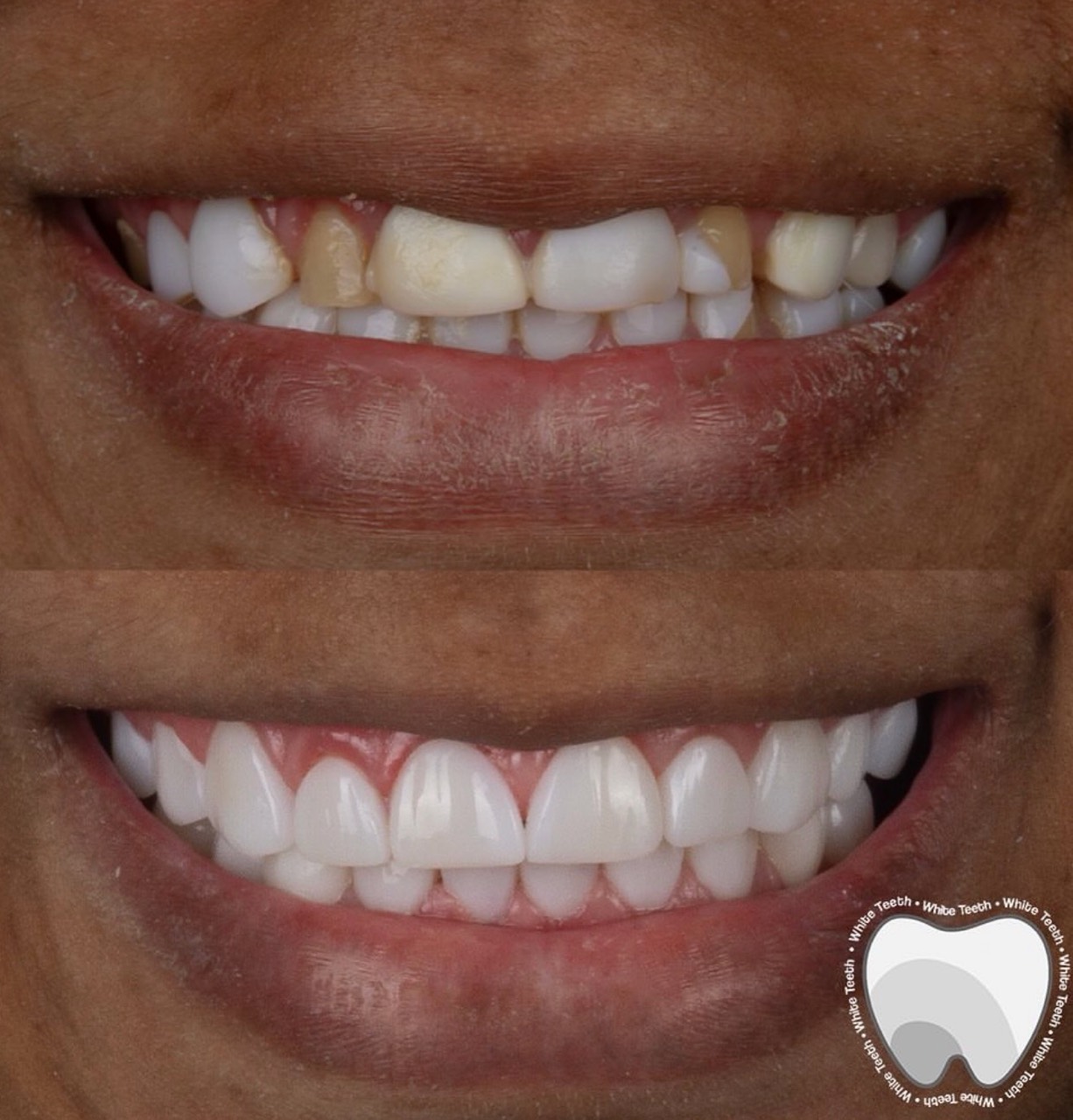 Natural porcelain veneers result before and after