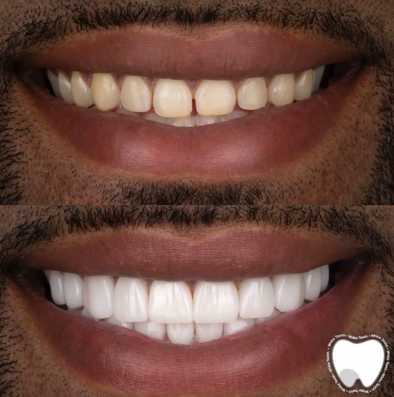 Porcelain veneers before and after result