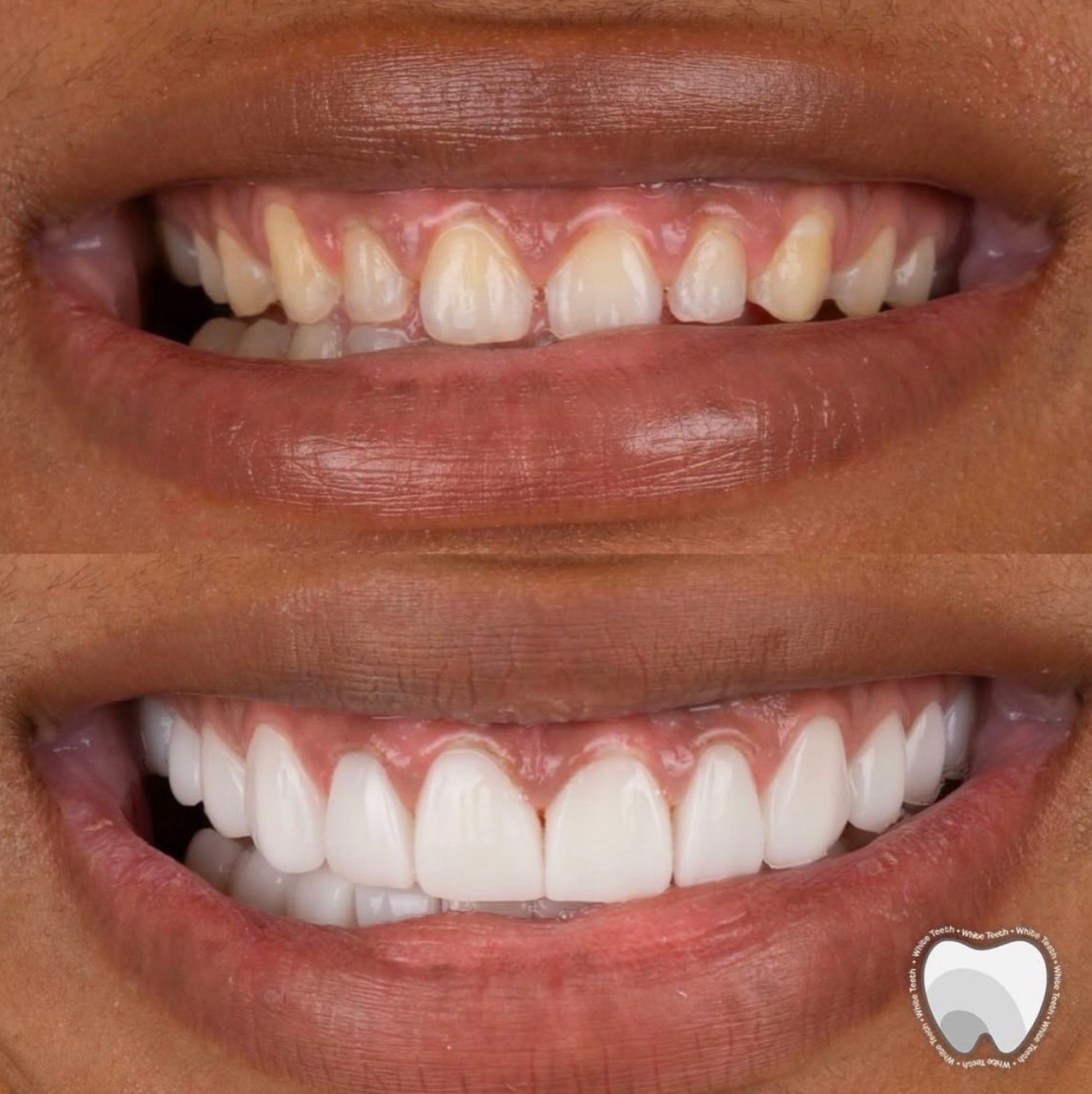 Aesthetic dental veneers transformation