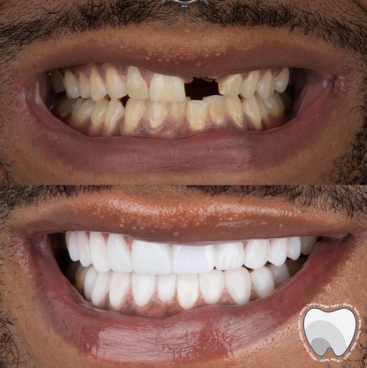 Full smile reconstruction before and after result