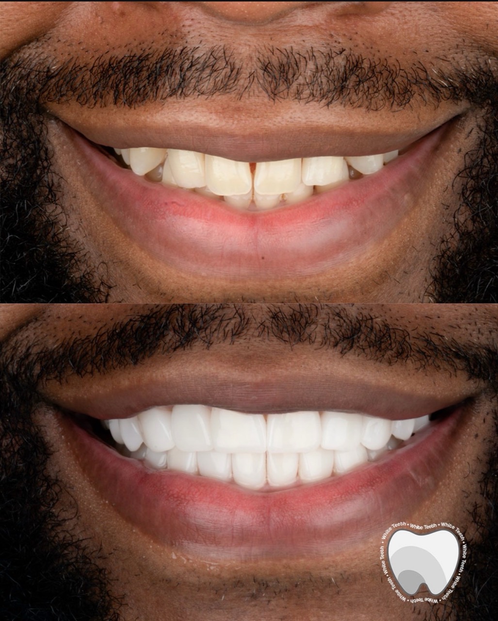 Porcelain veneers before and after
