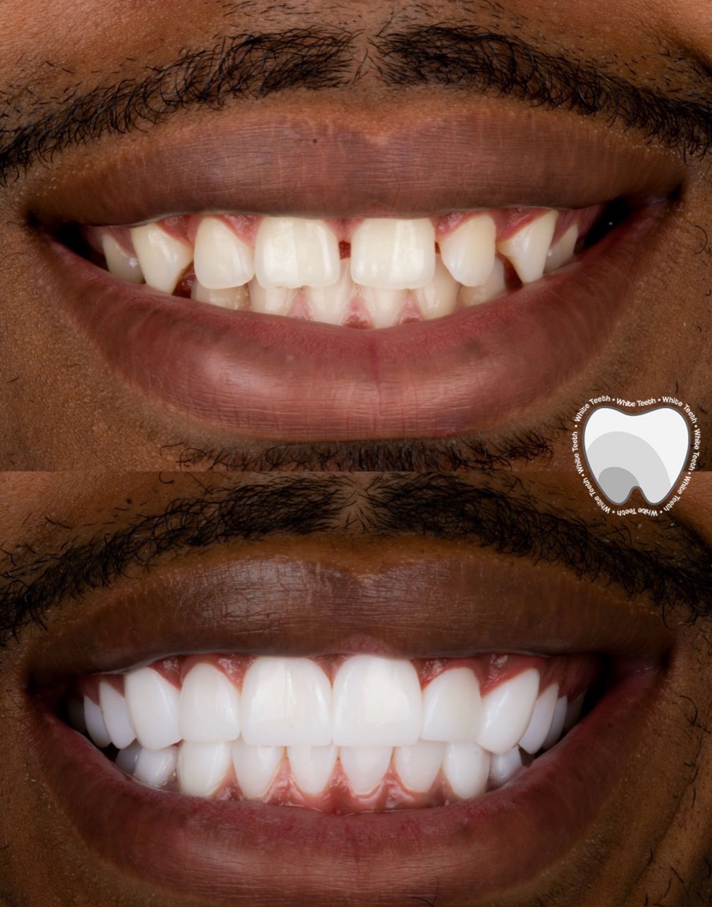 White porcelain veneers transformation