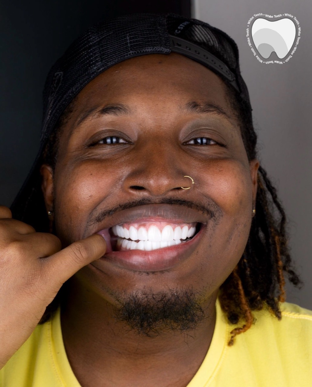 Patient smiling after dental veneers in Colombia
