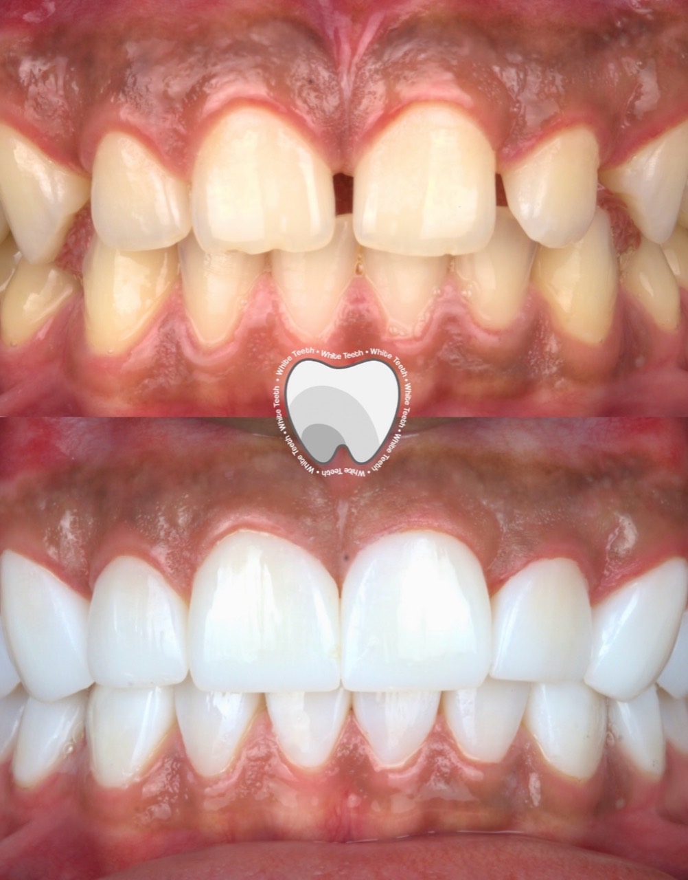 Cosmetic dental before and after close up