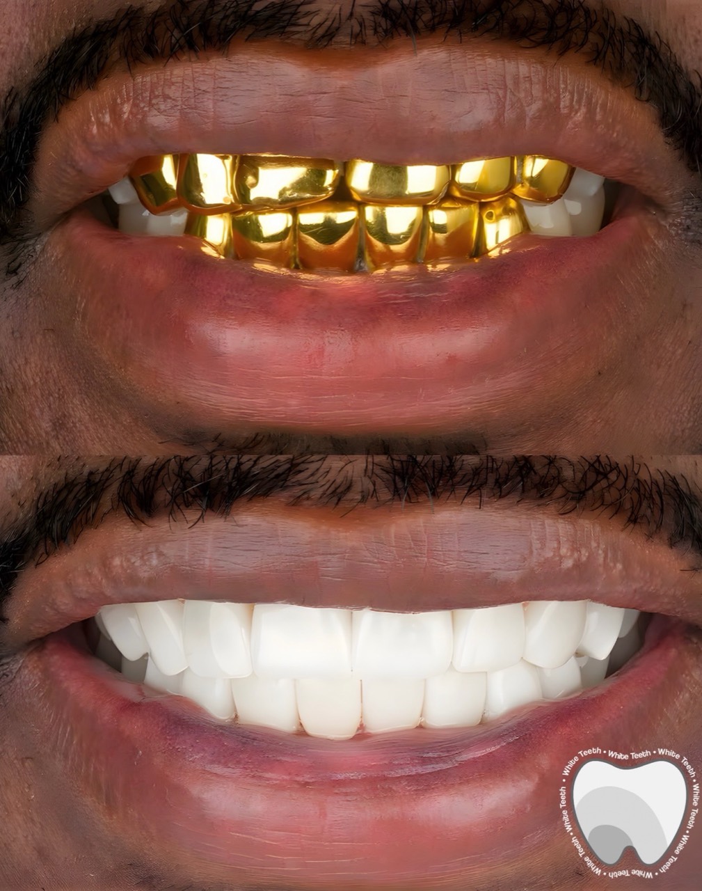 Gold teeth transformed into white porcelain veneers result