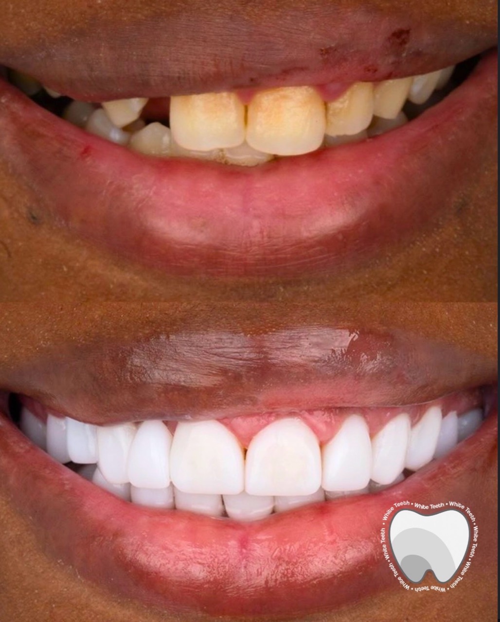 Natural white smile transformation before and after