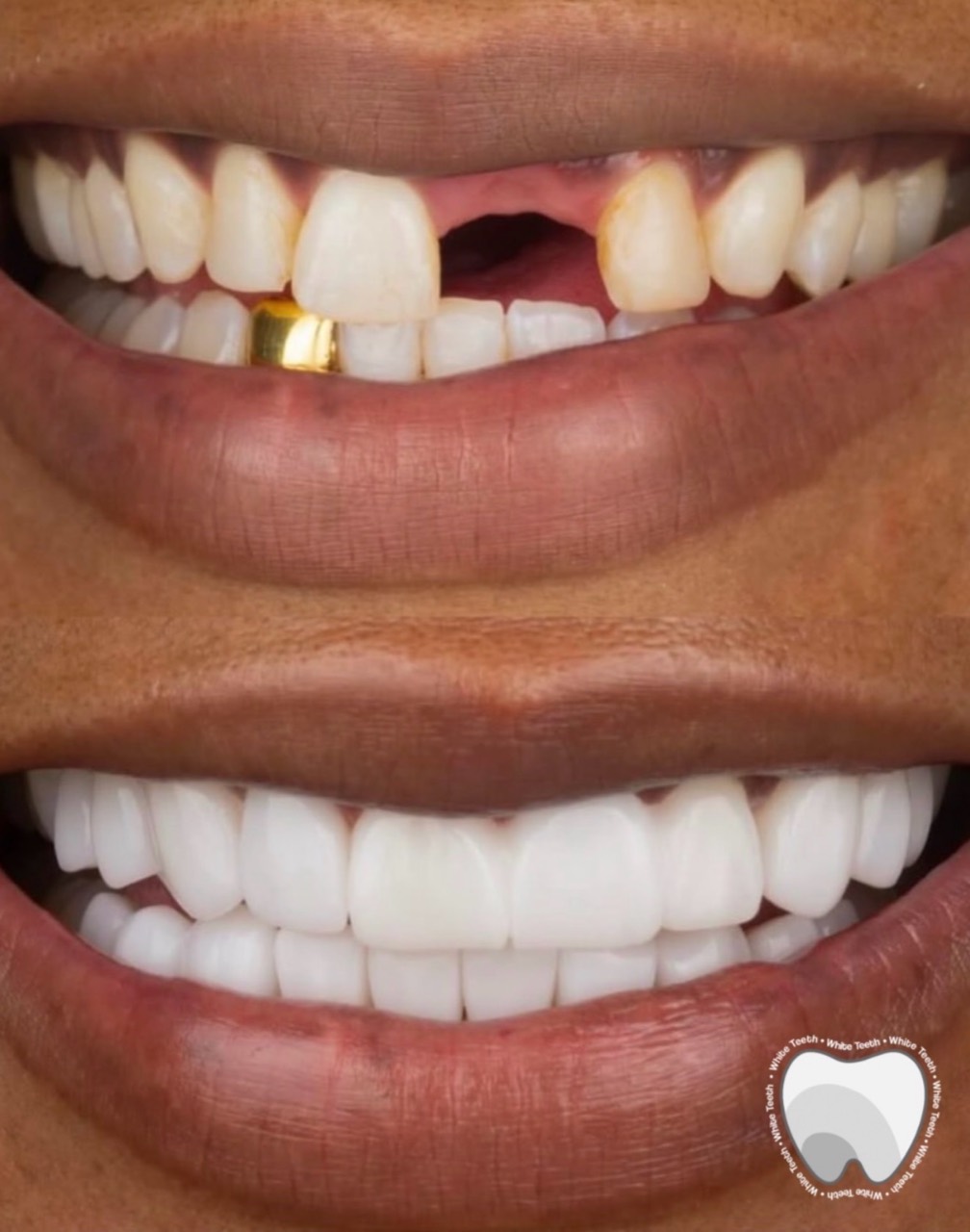 Missing tooth restored with full porcelain veneers result