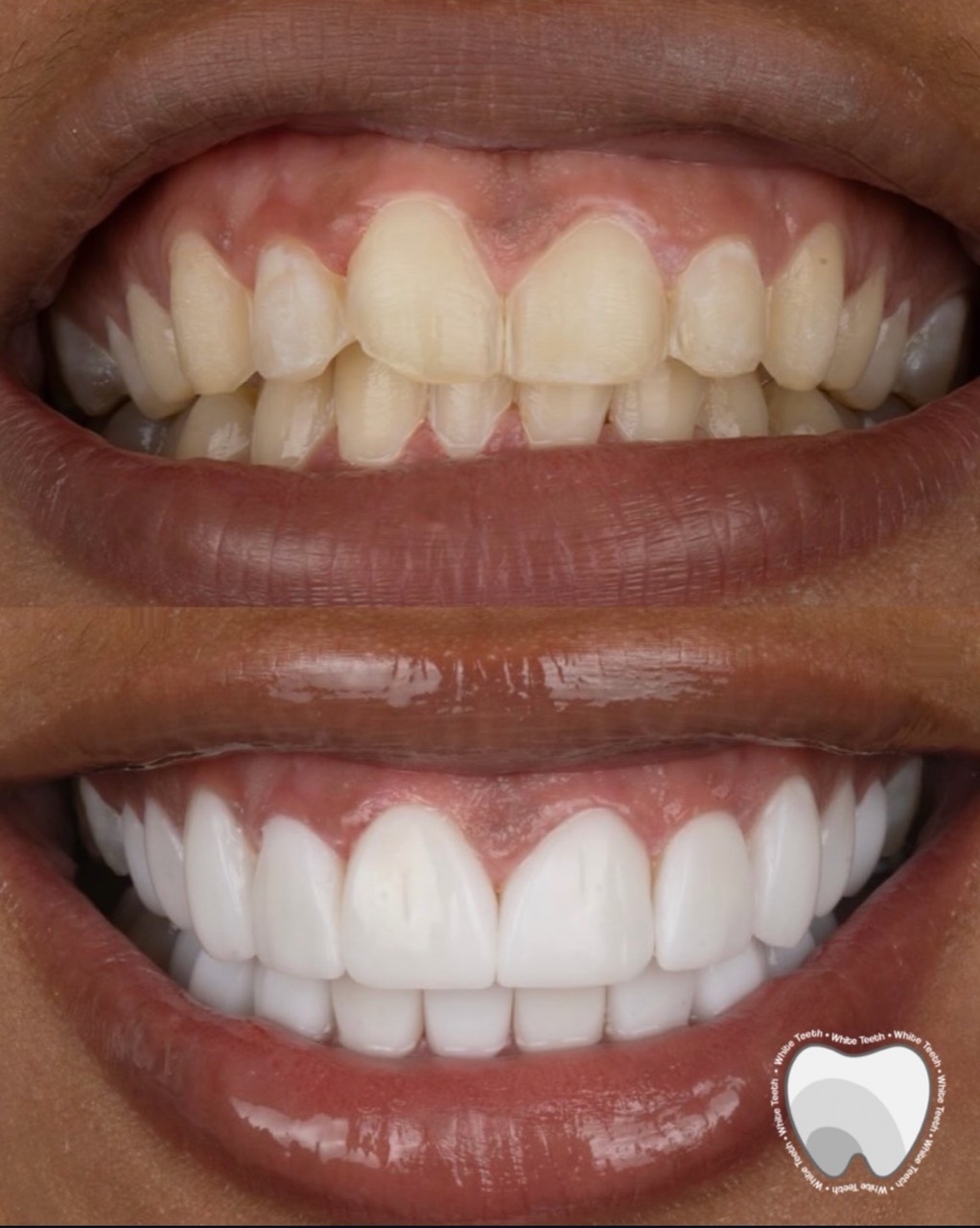 Bright veneer smile before and after transformation