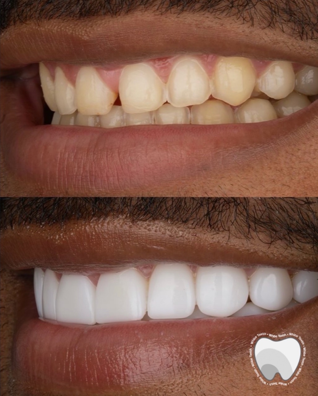 Porcelain veneer before and after side smile view