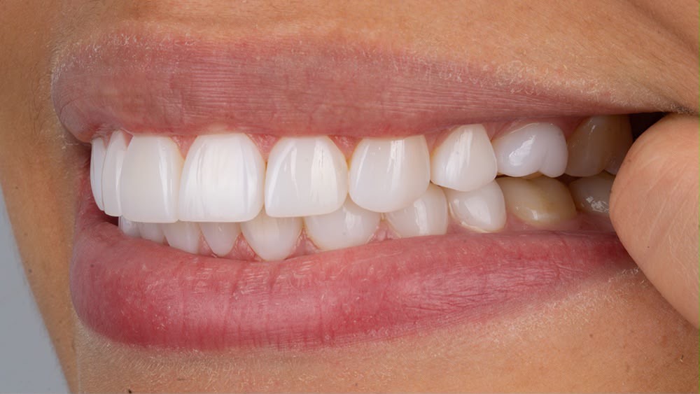 Example of a bite photo