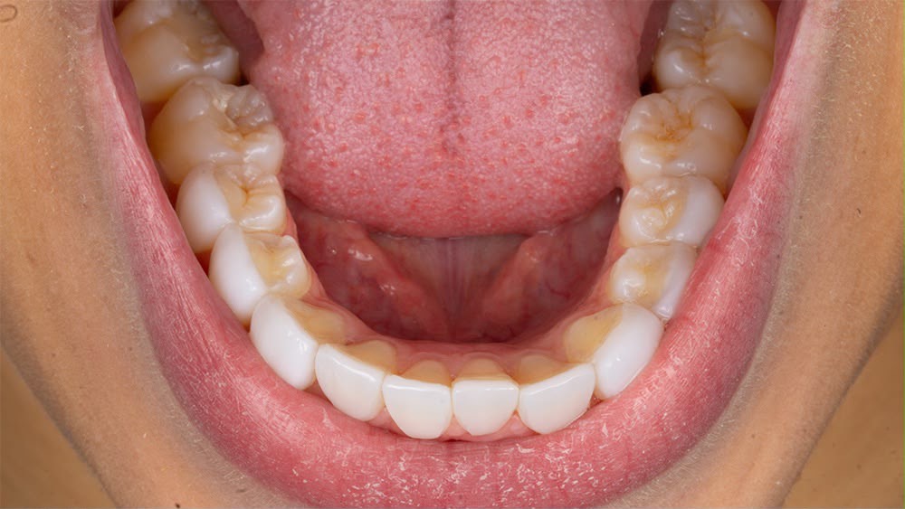 Example of a lower teeth photo