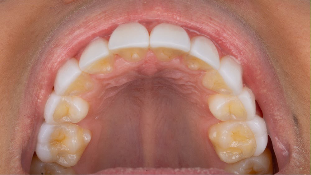 Example of an upper teeth photo